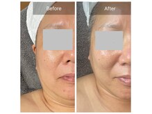 最新美容機器アクアダーマで真皮深層に美容液を導入して肌改善へ