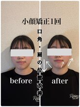 リバイブ 自由が丘店(REVIVE)/小顔矯正+ドライヘッドスパ1回