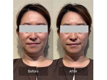 菫鍼灸院の雰囲気（頭皮鍼付き全顔美容鍼で、左右差やたるみを改善します）