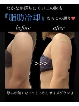 アールズ スリム(R's slim)/脂肪冷却で二の腕スッキリ！痩身