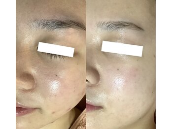 サロン ド グレイシャス エステティック(Salon de GRACIOUS esthetic)/育肌ハーブピーリング