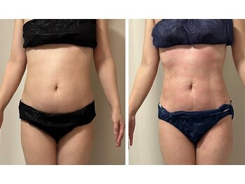 ひぺりかむ/ハミ肉/浮き輪肉悩みはサロン♪