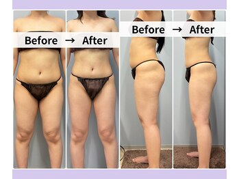 ベルミーランド 浜松天王/痩身Before→After