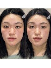 ブリューテ(Bluete)/ニキビ肌や毛穴も目立たなく！