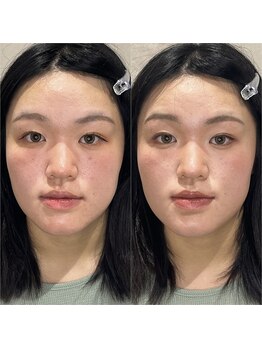 ブリューテ(Bluete)/ニキビ肌や毛穴も目立たなく!