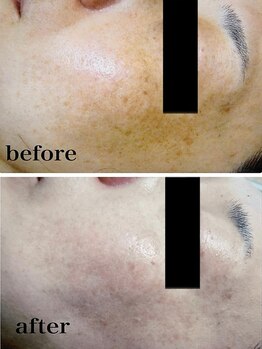 ブランシェ 金沢店 × 椿/シミケア　お客様