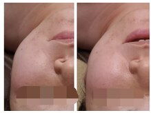 ウォーマル(warmaL)/小顔矯正/1回でも変化はある！