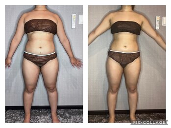 ブリス(bliss)/ウィンバック痩身の効果！