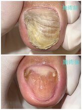 レフス 北参道店(REFUSS)/長年抱えていた爪のトラブル