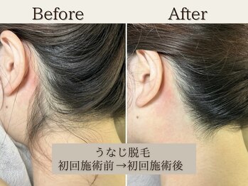 インベスト(INVEST)/うなじ脱毛