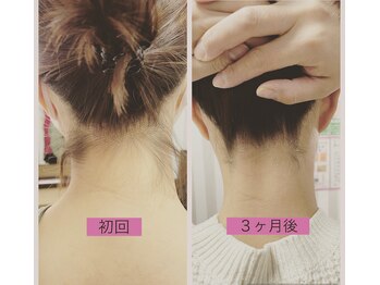 ヒトノワ(hitonowa)/【うなじ脱毛】