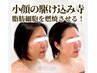 【小顔No.2★】首までケア◎脂肪燃解3ml＆リフトUP 顔＋首 ¥42,900→¥26,000