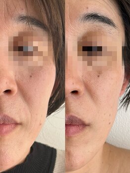 ルアンビューティー メディカルプラス(Luan beauty MEDICAL+)/チタニウムリフト×1回