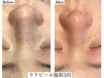 フレイヤ(FREYA)/ララピールBefore→After