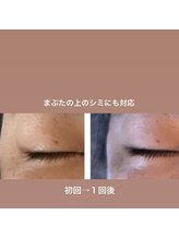 ジュエル(jewel)/低周波シミケア