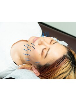 鍼灸施術を受けたい