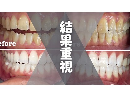 ティースホワイトニング 沖縄うるま市(Teeth Whitning)の写真
