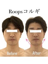 ループス(Roops)/ビフォーアフター【コルギ】