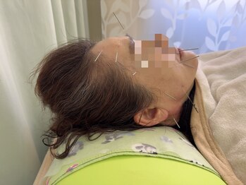 命水鍼灸院/顔面不調【新宿/鍼灸】