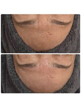 シュガー(Sugar...iyr)/REVI陶器ピーリング！！