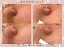 メゾンリュバン 天王寺(Maison Ruban)の雰囲気（黒ずみ/角栓/毛穴開きにワンランク上の高美白毛穴ケア◎）