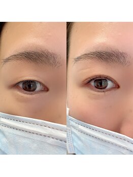 アイビューティー(AI beauty)/ダブルアイリフト＋ヒト幹細胞
