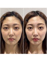 ブリューテ(Bluete)/小顔を一瞬で叶えるメイクです☆