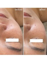 エクラ(eclat)/REVIハーブピーリング