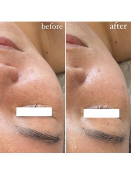 エクラ(eclat)/REVIハーブピーリング