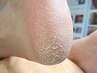 【かかとケア】踵の角質ケア価格◎　¥5,500