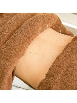 南行駅近整骨院/腰に効く鍼