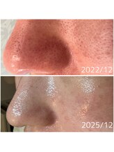 メープルサロン(MAPLE SALON)/毛穴リセットコース