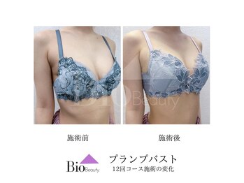 バイオビューティー 神戸本店(Bio Beauty)/プランプバスト　12回コース症例