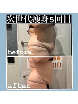 ミユサロン(Miu-salon)/次世代型痩身5回目