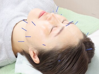 たかはし整骨院の写真/【初めての方も◎】美容鍼を受けるならココ！むくみ・たるみ改善・リフトアップ・ハリツヤのお悩みに！