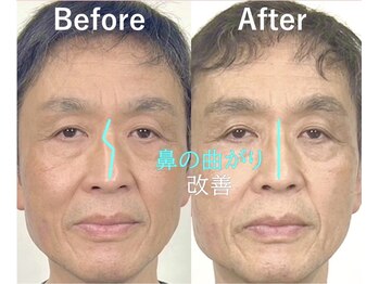 ラプリナーゼ 吉祥寺店(Raplit Nase)/隆鼻＋輪郭小顔矯正40分10回