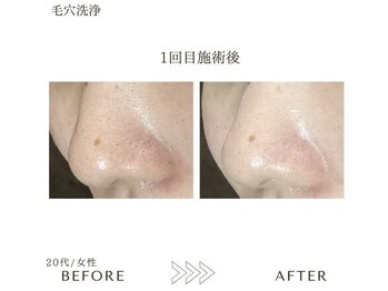 サロンエイトミー 西船橋店(salon 83)/【毛穴ケア】鼻の毛穴汚れ改善