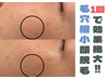 お肌悩みのケア＋顔脱毛ができる？！『プラズマ顔脱毛』