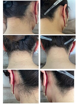 リードン(Reedon)/レディースうなじ脱毛