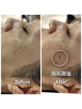 エクラ(eclat)/メンズハイドラフェイシャル