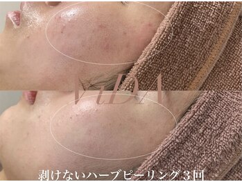 ヴィーダ 渋谷松濤(ViDA)/乾燥/繰り返す肌荒れ改善