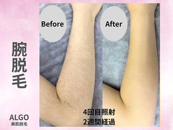 アルゴ 山口宇部店(ALGO)/ショット数4倍で効果抜群!