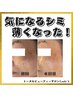 【ファンデ卒業♪】エレクトロポレーションで奇跡のシミ集中ケア!!美肌へ☆