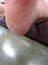 フットケアサロン ラビフット(Rabbi foot)/皮膚めくれのケアはお早めに