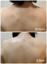 リュミエール デスポワール(Lumiere d'espoir)/背中ハーブピーリング