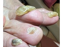 アトリエ整骨院/爪切り