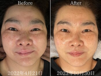 リカバリー (Recovery)/小顔矯正×幹細胞美容鍼