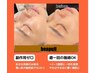 導入記念！美容韓国で一番人気肌を育てるピーリング【ララピール＋再生LED】