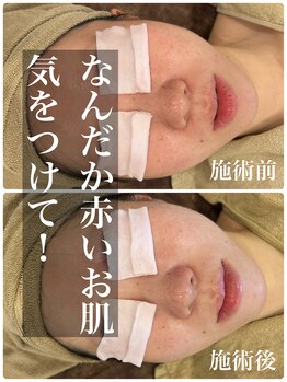 マルコ(marco)/赤みケア、徹底毛穴洗浄