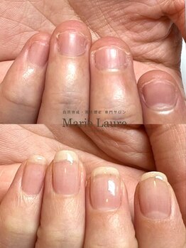 マリーロール 梅田店(Marie Laure)/自爪育成/深爪矯正/ネイルケア